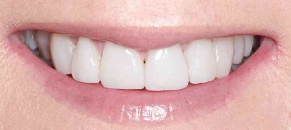 After-(2)-Porcelain-veneers