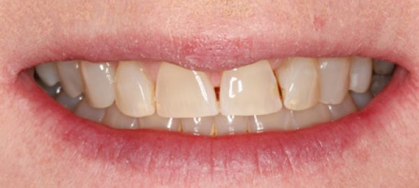 Before-(2)-Porcelain-veneers