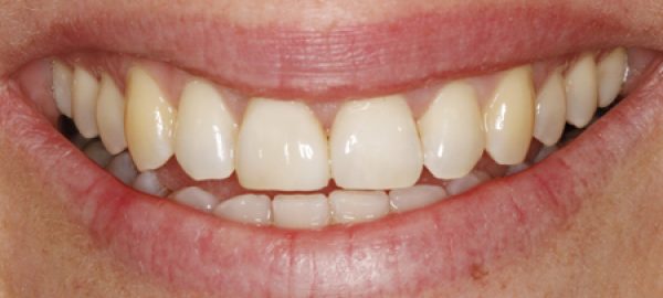 Comp-Veneer's-after-and-single-tooth-bleaching