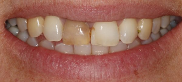 Comp-Veneer's-before-and-single-tooth-bleaching