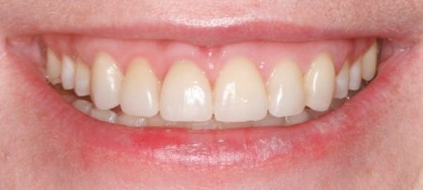 Orthodontics, gum reduction, bleaching and porcelain veneers made a drastic improvement to her smile.