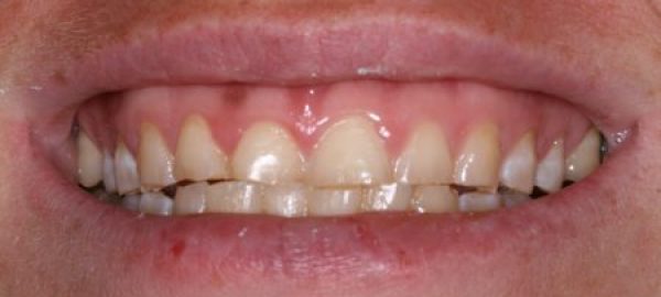 A fairly common bite discrepancy was causing this patient to wear down her front teeth.